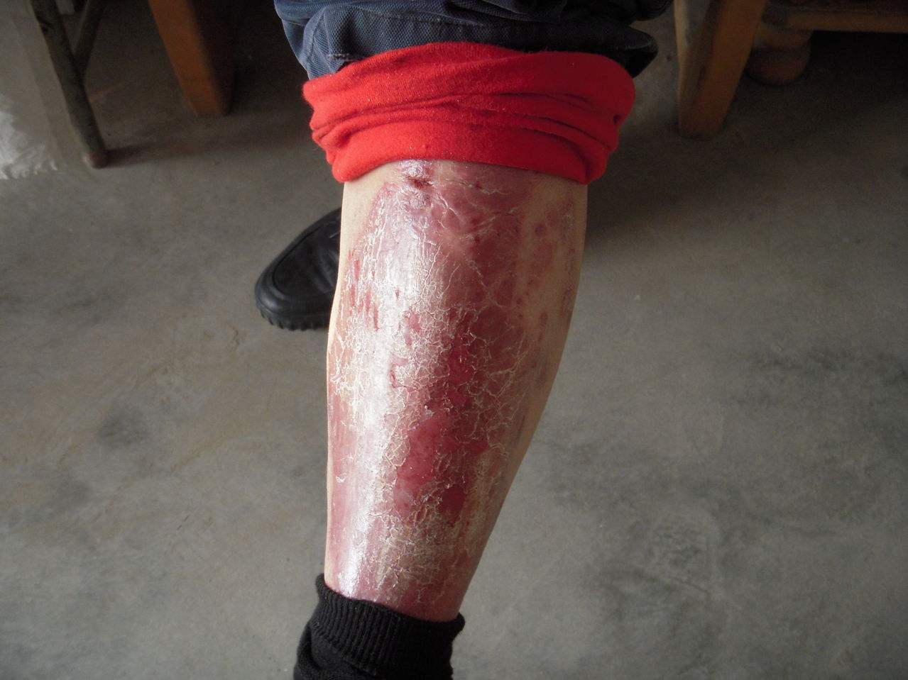 [热点推送]东莞最专业银屑病医院-东莞治疗银屑病正规医院【东莞哪里治疗银屑病治疗的好】