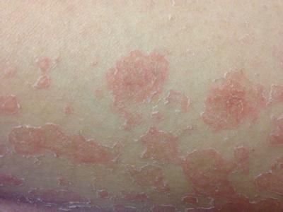 牛皮癣治疗的基本方法都有哪些