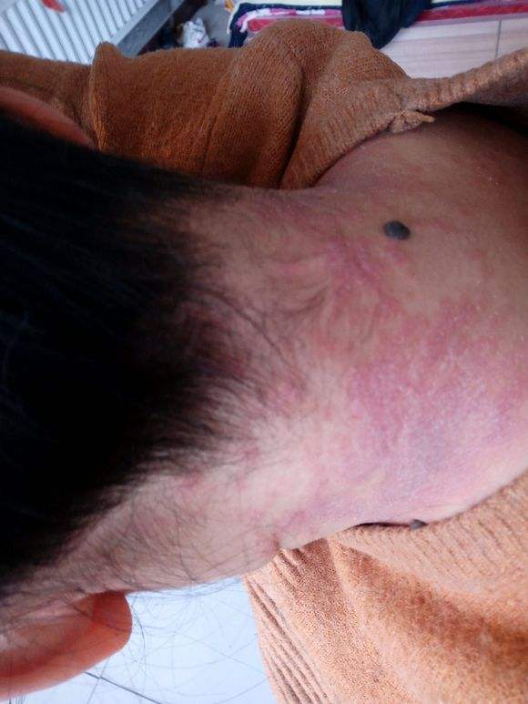 牛皮癣的护理要怎么做