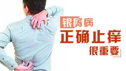 治疗牛皮癣的方法都有什么呢