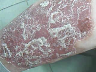 牛皮癣患者饮食有讲究