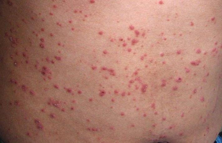 如何缓解牛皮癣瘙痒带来不适感