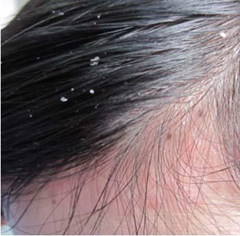 治疗头部牛皮癣一定要剃光头吗