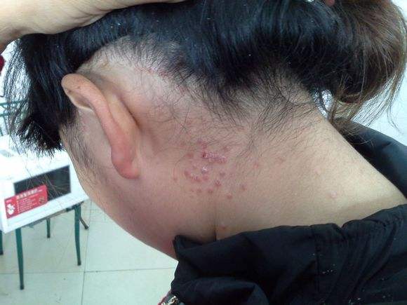 头皮型银屑病越来越严重怎么回事