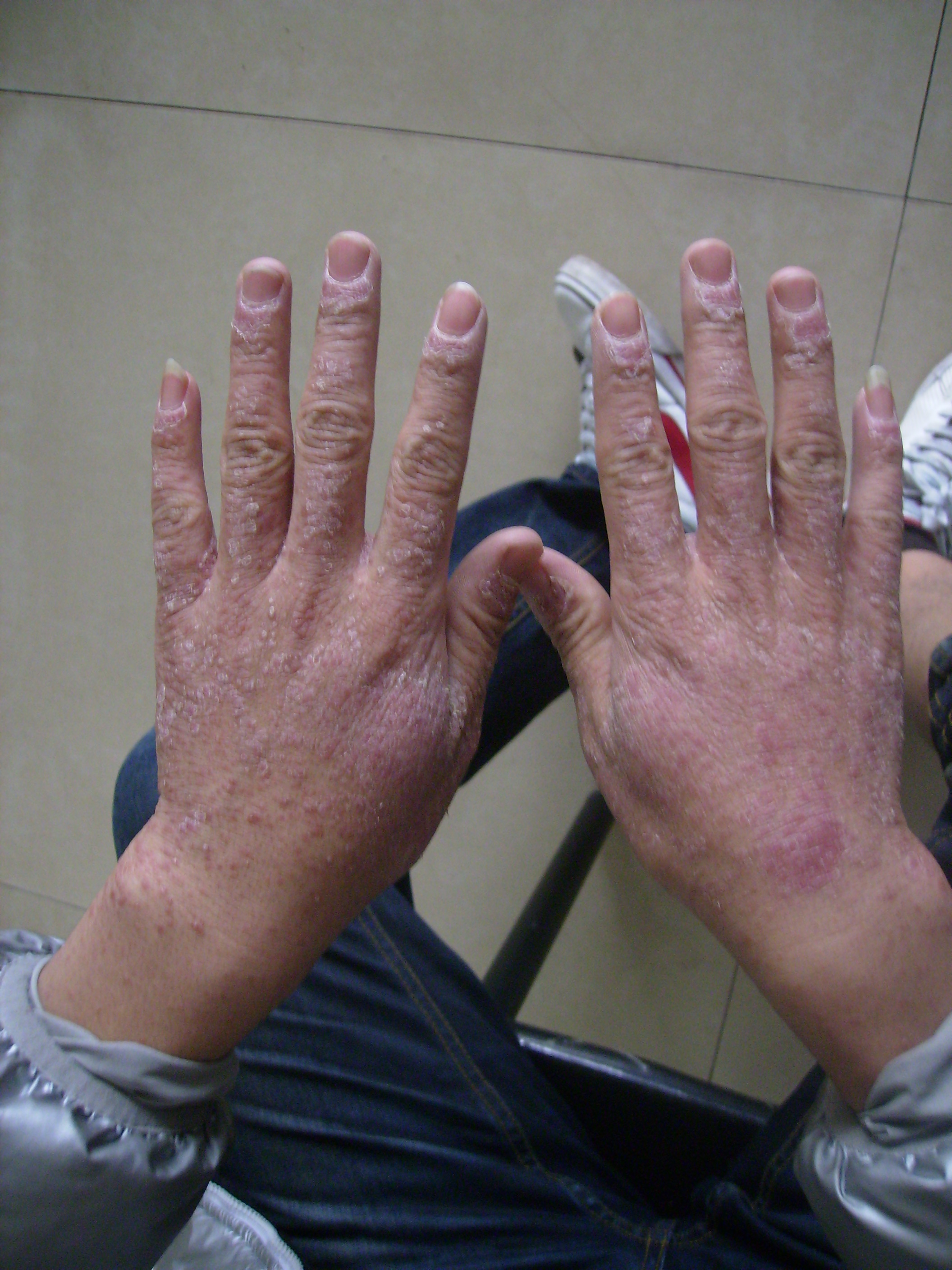 关于牛皮癣治疗的常识性错误