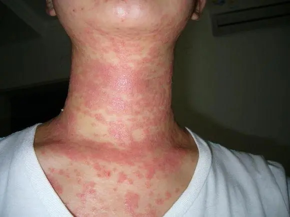 牛皮癣与脂溢性皮炎有何区别