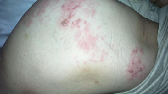 感染与牛皮癣之间的关系如何