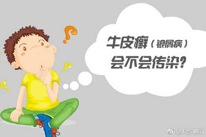 银屑病所产生的危害广州专家来谈谈