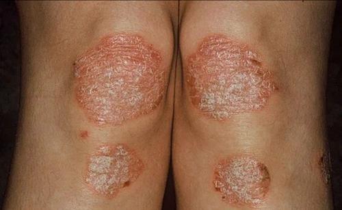 吃牛皮癣的药物后来怀孕了该咋办