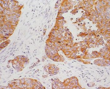 身体上出现银屑病一定要治疗吗