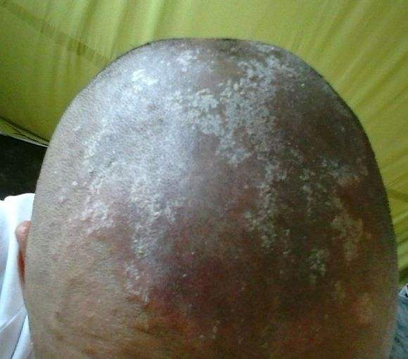 成年人要知道的银屑病病因