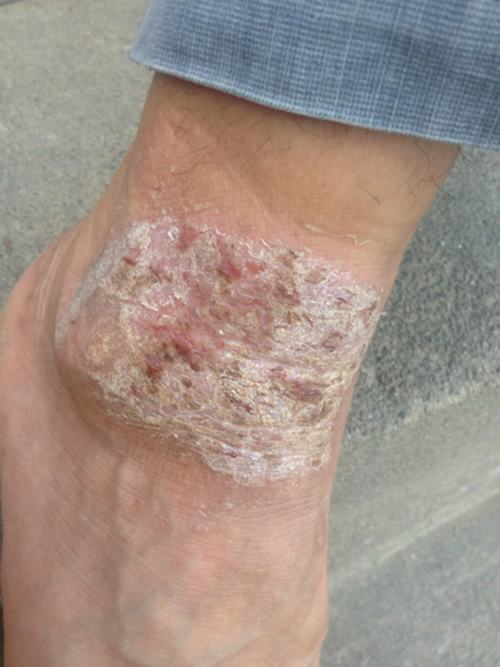 牛皮癣患者对付失眠的好办法呢