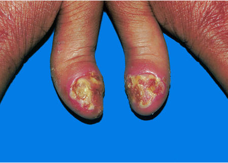 不要妄想银屑病会不治而好