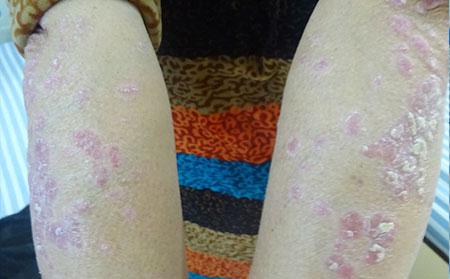 银屑病容易形成大花脸该如何防范