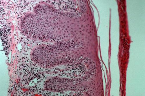 牛皮癣病因问广州新世纪