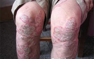 牛皮癣病人可以用纹身来掩盖皮损吗