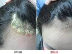 头皮型牛皮癣病人如何护理好自己的头发