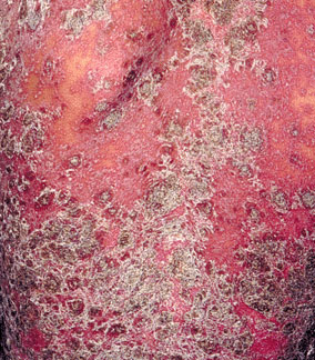 红皮病型牛皮癣到底怎么治疗