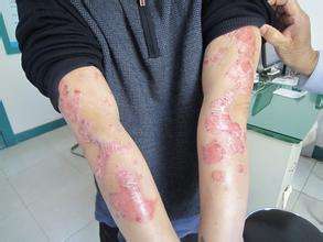 患上红皮病型牛皮癣要怎么治疗