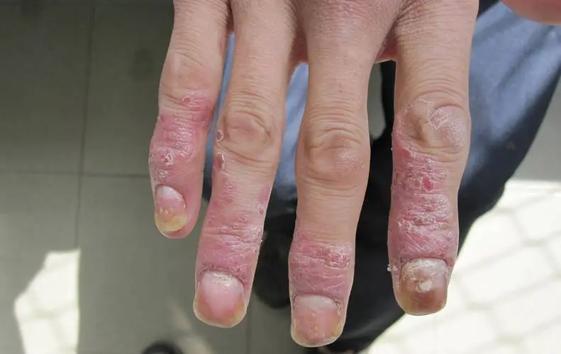 牛皮癣患者能否吃杏干