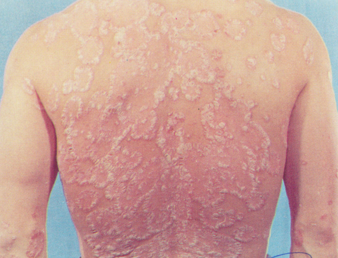 老年人容易患上牛皮癣的原因有哪些呢