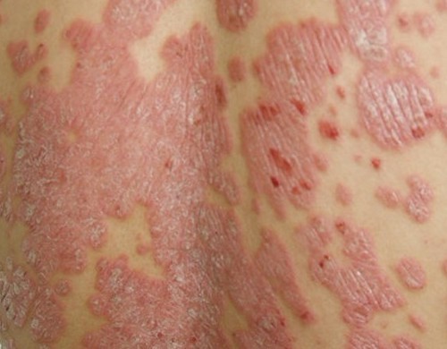 牛皮癣对人体的危害表现在哪里呢