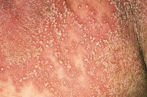 牛皮癣的治疗莫要追求快以免陷入用药陷阱中