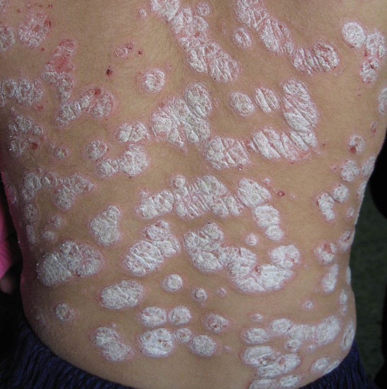 牛皮癣患者切忌空腹饮用牛奶浓茶吗