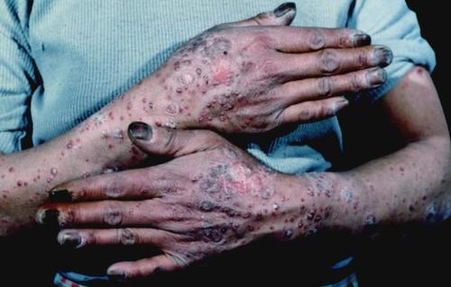 携带易感基因并不会直接导致牛皮癣发病