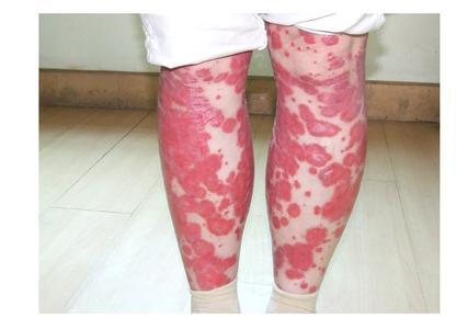 控制牛皮癣病情的关键在于如何稳定自己的情绪