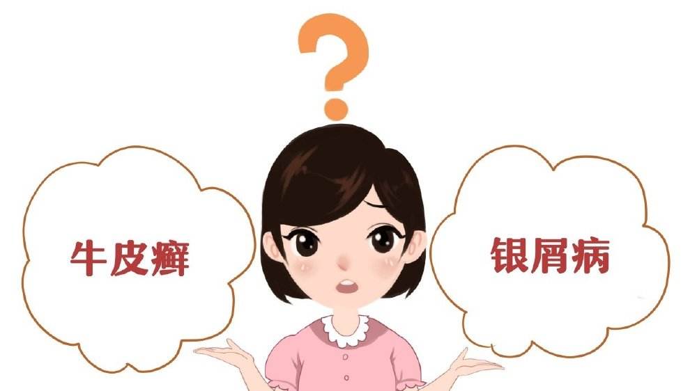 银屑病进行期啥症状你完全猜不到