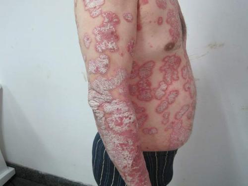 夏季牛皮癣缓解期防治重点在哪里