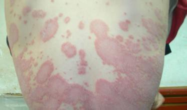 是牛皮癣夺走了你的灿烂笑容