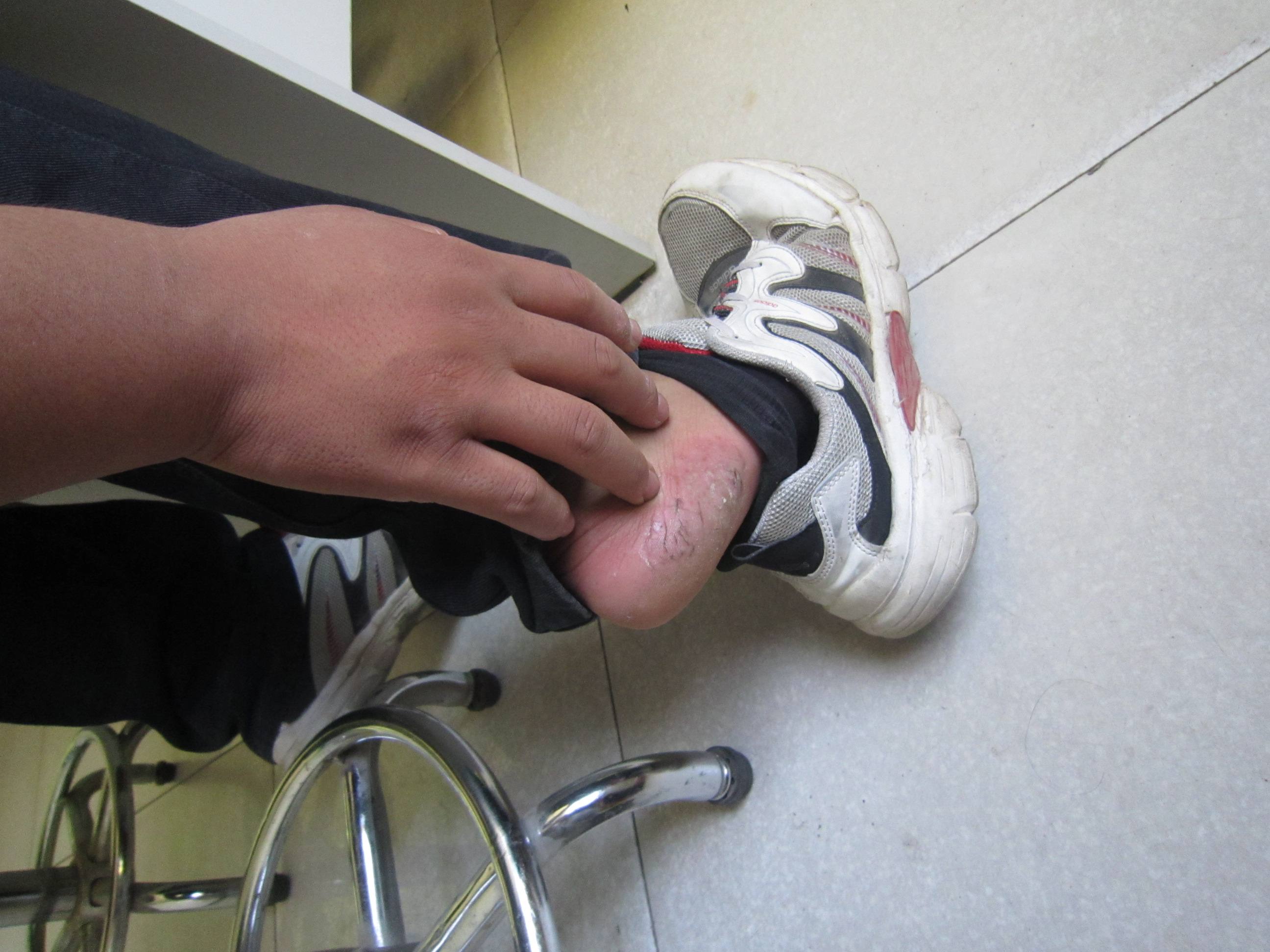 患上牛皮癣的症状是会有什么呢