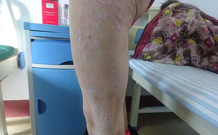 牛魔王坏脾气不可深交:如何区分牛皮癣与其他皮肤疾病