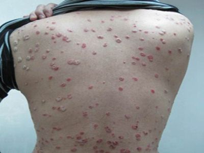 关于牛皮癣疾病它会不会影响患者们的生活质量