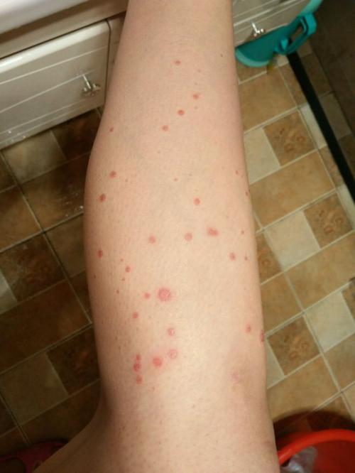 广州医生提醒牛皮癣病情顽固，治疗需慎重