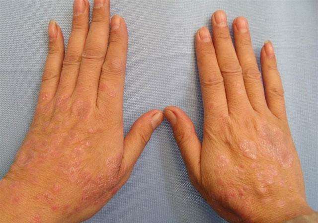 患上银屑病时这个疾病会发生什么样的变化呢