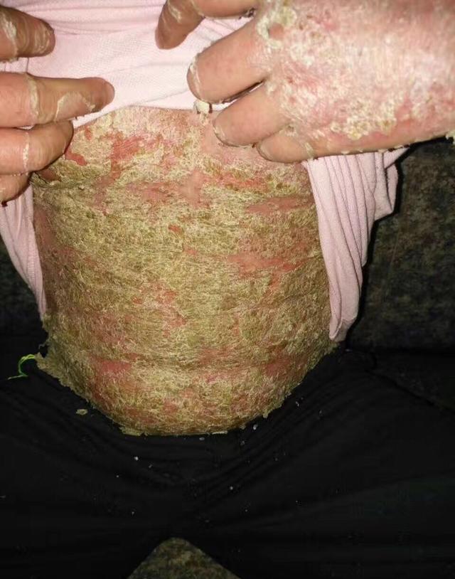 萌芽期的牛皮癣症状是什么样的呢?