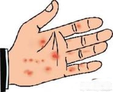 广州医院救治牛皮廯常见的诱因有哪些