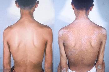 初期牛皮癣怎么护理