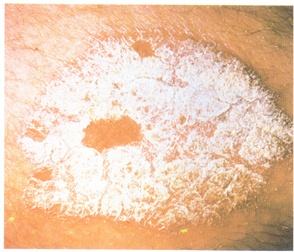 成年男性患上牛皮癣为啥多于女性,可以避免患上牛皮癣吗