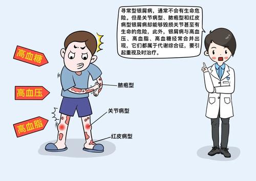 诊治银屑病的费用高不高