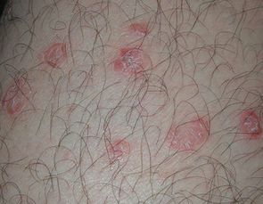 牛皮癣怎么治疗比较好关键及早用药