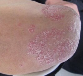 患了银屑病早期会出现哪些症状呢