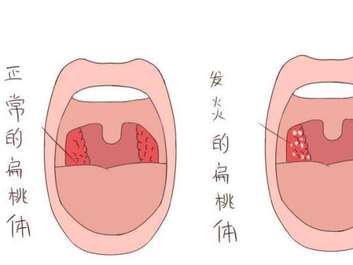 切除扁桃体是否真的能治疗青少年牛皮癣