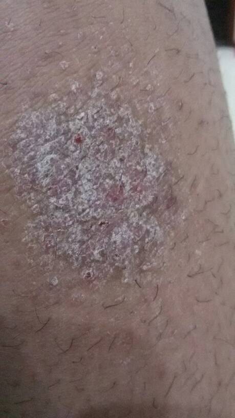 头部牛皮癣会导致头发干枯吗