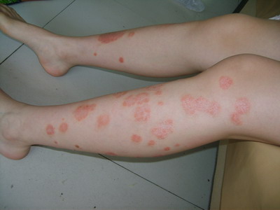 平时常喝南瓜汤能有效治愈牛皮癣