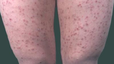 牛皮癣治疗和预防应该如何公平对待