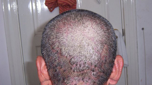 牛皮癣患者要怎么洗头最好呢？